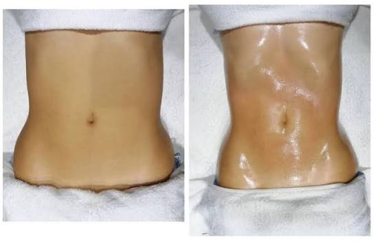 Resultados Post Operatorio
